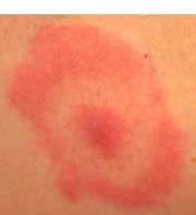 Erythema migrans (EM) : -Bara 50 % av patienter minns fästingbett. (72% av klinisk Borrelia) Klinisk diagnos!