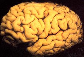Alzheimerdrabbad