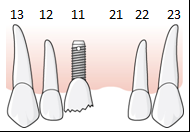 107 (114) 6.5.8.4.2 Exempel, skada på befintlig implantatkrona i en entandslucka, skadade komponenter En patient har sedan många år ett singelimplantat i position 11.
