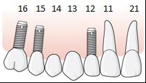 81 (114) I exemplen i bilden ovan kan regel E.2 tillämpas när ett implantat inte kan placeras inom tandposition 5 5. Då ersätts istället ett implantat med implantatkrona i tandposition 6.