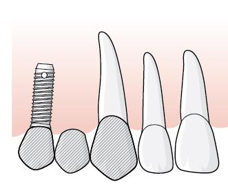 96 (114) Efter att 43 tagits bort fastställer tandläkaren tillstånd 5447 och ett implantat installeras i tandposition 42. Åtgärd 420 rapporteras för implantatet och åtgärd 421 för operationen.