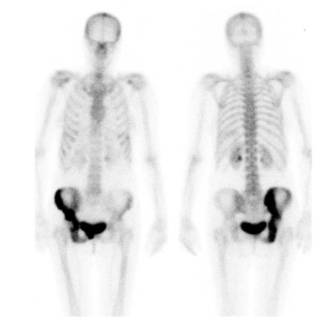 Fall 2 78-årig kvinna med bukmalignitet, sannolikt ovarialcancer.