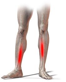 Benhinneinflammation (Medialt Tibiasyndrom) Smärta på insidan av skenbenet i samband med löp- och hoppträning. Extra vanligt hos distanslöpare.