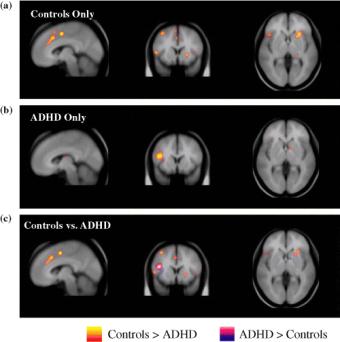 The neural correlates of attention deficit