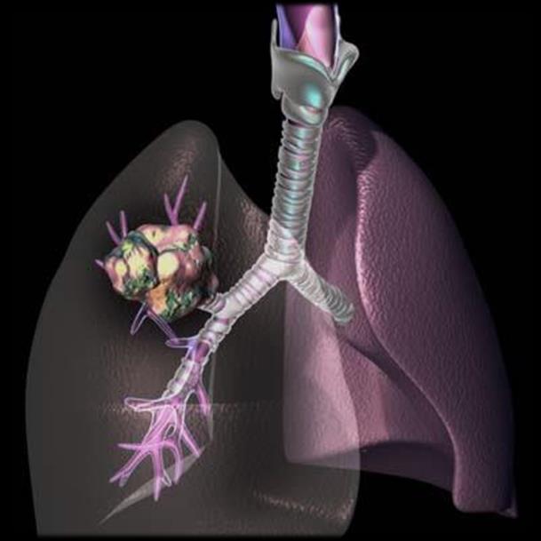 Lungcancer