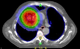PET/CT-based BTV (i GTV )
