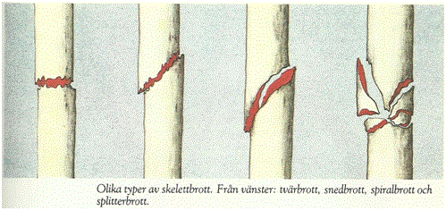 Figur 3. Olika typer av skelettbrott (Peterson & Renström 1983 s. 19). Stressfrakturer kan orsakas av överbelastning vid upprepade tillfällen t.ex.