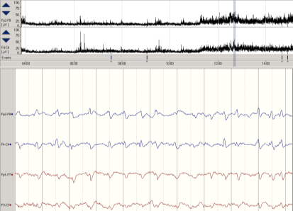 tumör metabol infektion hypoxi/anoxi stroke trauma intox okänd Etiologi Subkliniskt SE hos 19% av komatösa patienter procent 45 40 35 30 25 20 15 10 5 0 koma med SE koma utan SE Symtomatisk