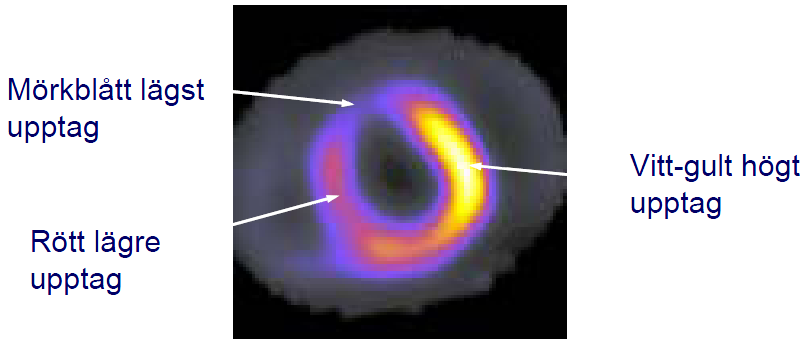 Myokardscintigrafi Skärpa ischemidiagnostik genom injektion av spårämne