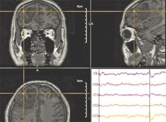 Vid känd epilepsi har denna första linjens behandling ofta givits prehospitalt.