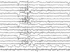 går [12]. Möjligheten att bryta ett epileptiskt korrelerar med den tid et pågått [2], och som läkare bör man göra sig bekant med sitt lokala schema så att behandling kan sättas in skyndsamt.