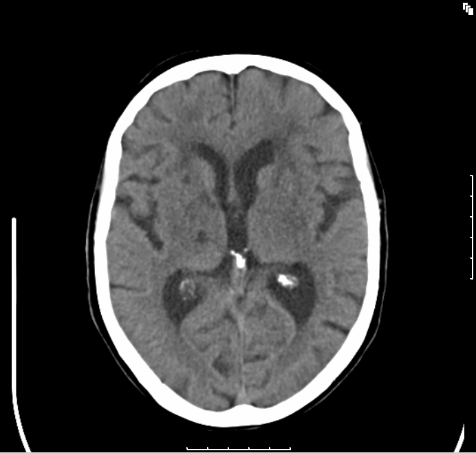 Stroke-syndrom Vid småkärlssjuka ( lacunära infarkter ) ses ofta isolerad förlamning