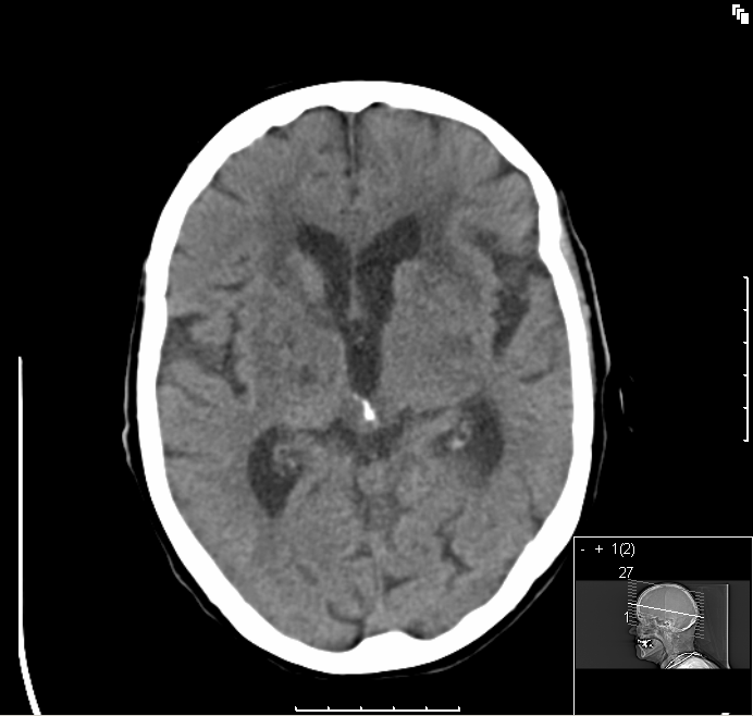 Stroke-syndrom Hos vissa patienter med småkärlssjuka utvecklas utbredda förändringar i hjärnan med