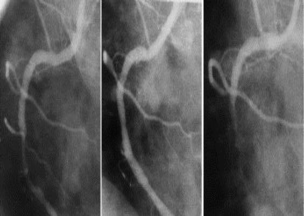 material (PCI = percutan coronar intervention)