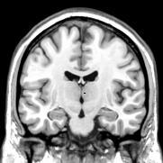 Alzheimers sjukdom och atrofi Start i entorhinalcortex och hippocampus Tidigt i sjukdomen, atrofi i