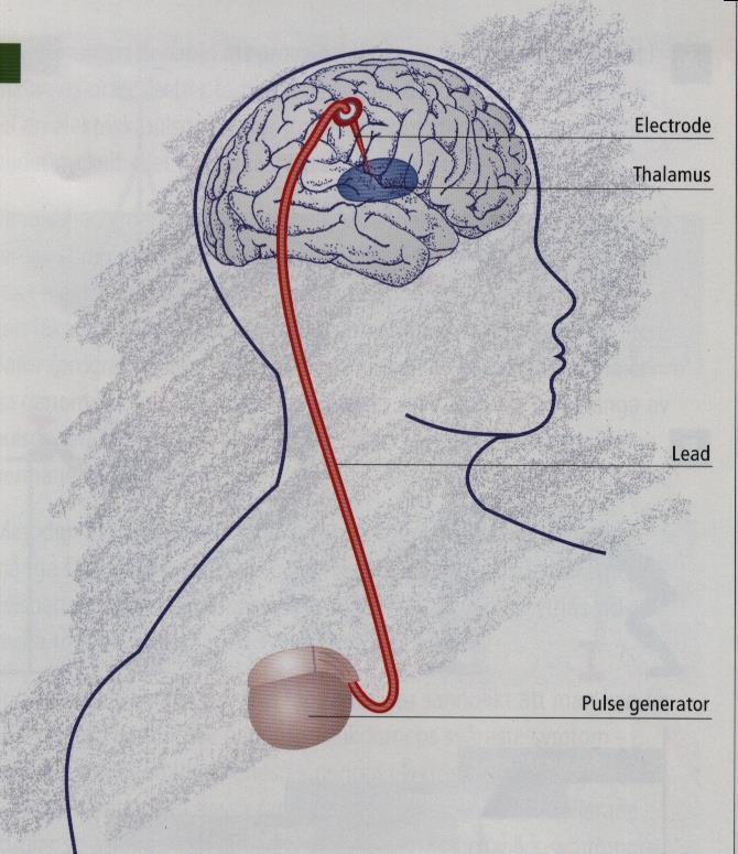 Kirurgisk behandling DBS - Deep Brain Stimulation Pulsgenerator