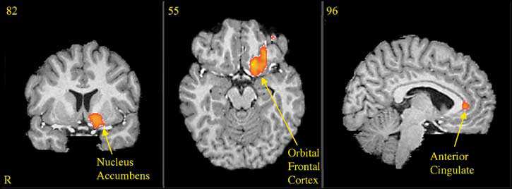 Amygdala aktiverad Naturfilm Maximal skattning av drogsug Svettningar, hjärtklappning Kokainfilm Adapted from Childress et al 1999 Orbitofrontalcortex Droginducerad Craving Craving Adapted from