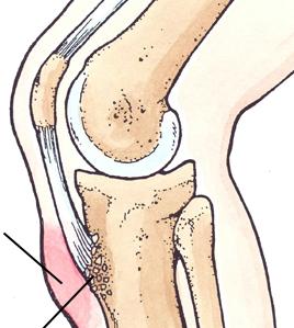 Mb Osgood Schlatter Tillståndet involverar infästet för patellarsenan i tuberositas tibia,