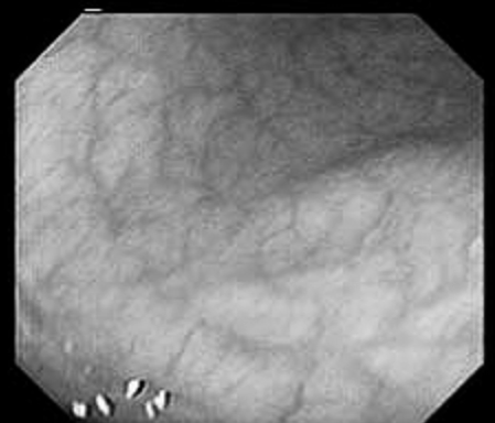Kronisk atrofisk gastrit Sjukdomar i ventrikel-duodenum: 2. Ulcus Ulcussjukdomarna: Godartade (d.v.s. ickecancer) sår i magsäck eller tolvfingertarm (drabbar 10% av befolkningen).