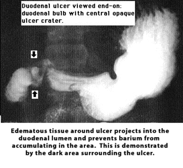 Ulcus (forts.): Symtom - Symtom vid ulcus: a. Sugande smärta, ofta nattetid, i övre delen av buken som lindras av mat: Duodenalsår, alltid HP-positiva. b. Illamående-kräkningar: Ventrikelsår, ofta men inte alltid HP-positiva.