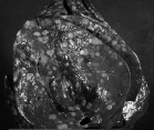 Levermetastaser från ventrikelcancer Sjukdomar i ventrikel-duodenum: 4.