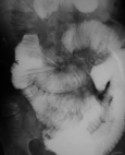Tunntarmsjukdomar: 4. Malabsorption Malabsorption: Reducerat näringsupptag i tunntarmsslemhinnan.