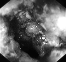 Tunntarms- Crohn Normal