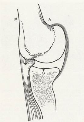 External impingement Definition inklämning av rotatorcuffen under coracoacromiala taket Neer 1972 Internal impingement Definition inklämning av rotatorcuffen mellan caput humeri och