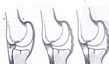 Sekundärt impingement ( Subacromial, Internal ) Scapulathoracal dysfunktion -rotatorcuffen och biceps får f r inte en fripassage under acromion i exempelvis kaströrelsen relsen -försämrar längdl