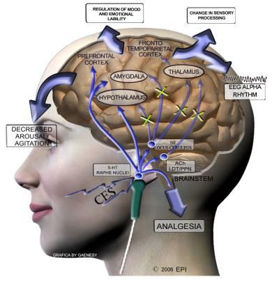 Depression: Neurobiologi Minskad aktivitet I PFC och Anterior Cingulate Cortex (ACC) Top-down processing ACC: brygga mellan uppmärksamhet coh emotioner, viktig