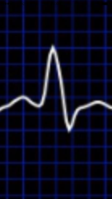 EKG Efter iphone EKG blev katterna kopplade till ett standard EKG med extremitetsavledning. I denna studie användes Cardiofax (ECG-9022K) Nihon Kohden.