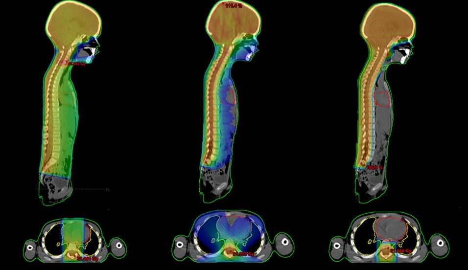 VARFÖR PROTONER VID BARNCANCER? Risk för solid sekundär cancer efter CSI av MB i barndomen 3D-CRT RapidArc IMPT Brodin P, Munck af Rosenschöld P, Aznar M et al.