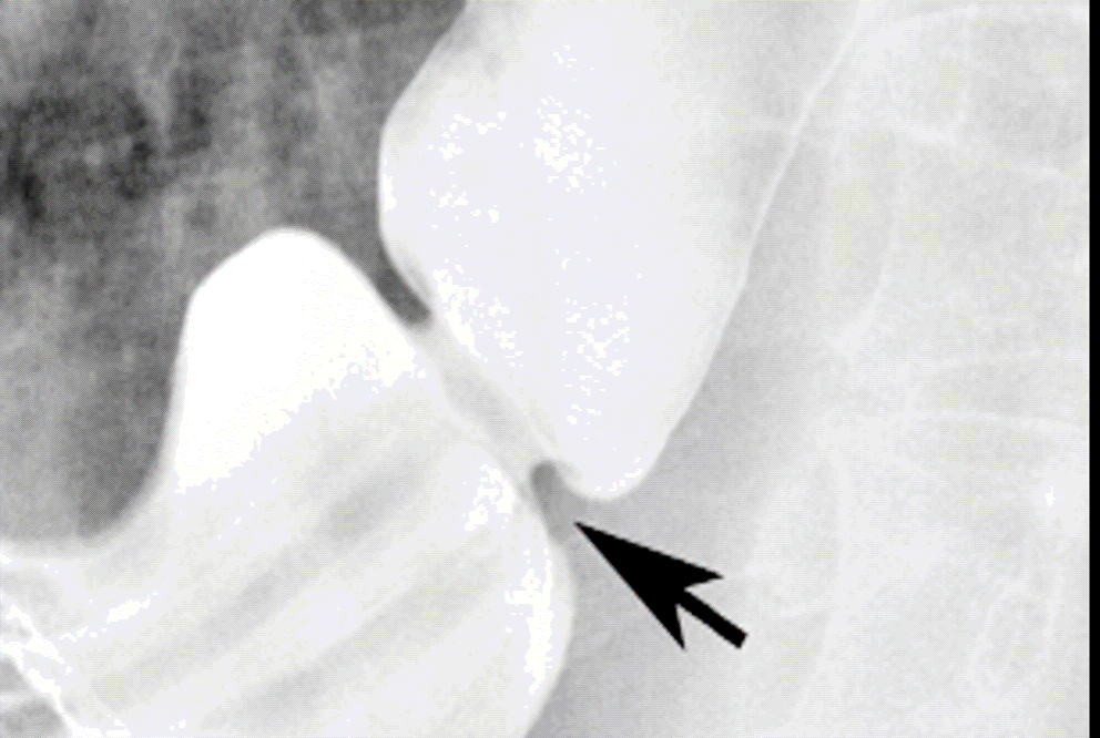 Schatzki s regel <13 mm Ø = symptom