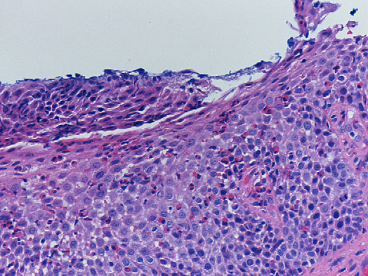 Eosinofil esofagit