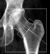 Bentäthet som riskfaktor WHO kohorten: Höftfrakturrisken ökar för