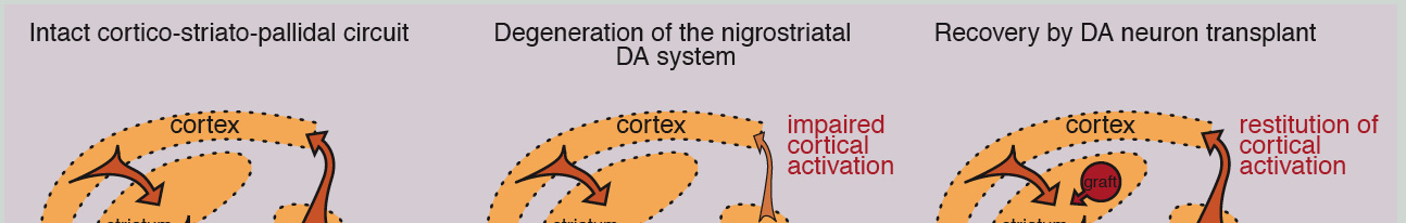 Stem Cell therapy in Parkinson s Disease Neuronal transplant in PD Lindvall O.