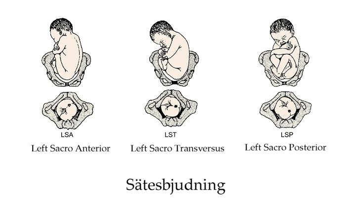 Om vårdgivaren misstänker ett ansikte presentation, bör kvinnan remitteras till ultraljud undersökning, för att bekräfta misstanken. Sätesbjudning 6 Figur 4.
