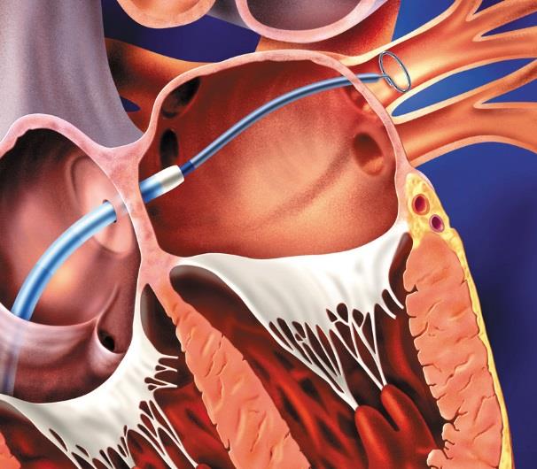 Pulmonary vein isolation (PVI) the cornerstone of