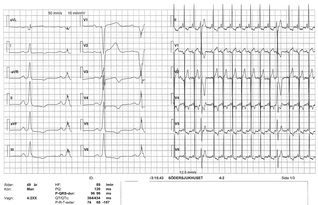 Fall 6. 49-årig man söker på akuten p g a bröstsmärta. Anamnes: Tidigare behandlats för hypertoni. F d rökare, slutade för 20 år sedan.
