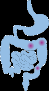 Kronisk Inflammatorisk tarmsjukdom - Ulcerös kolit & Crohns sjukdom Ulcerös kolit + Crohns Sjukdom = IBD Normal slemhinna i kolon Måttlig inflammation vid