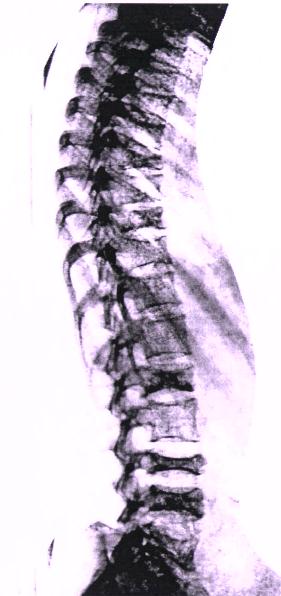 Osteoporos är en kronisk sjukdom Folksjukdom, vårdprogram och