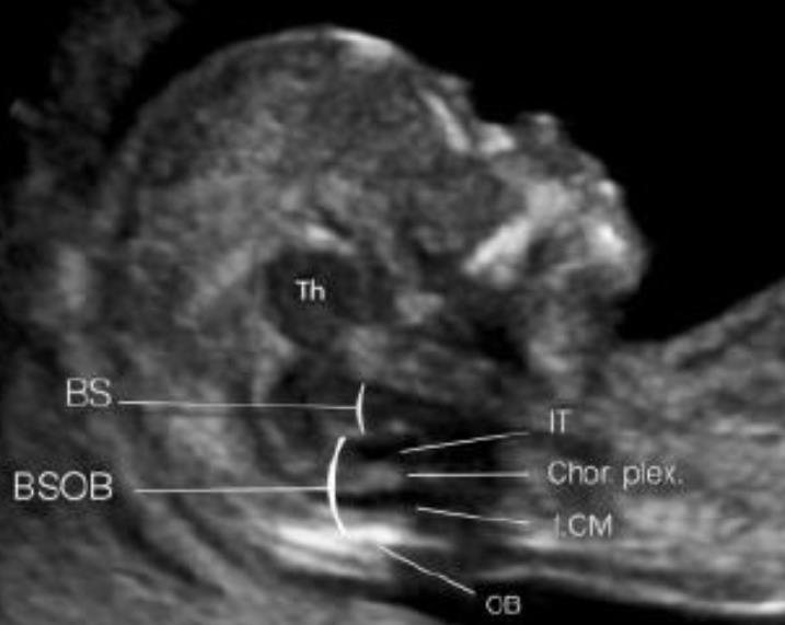 Värde av första trimester ultraljud Möjlighet till diagnostik av: PE, IUGR, 90%, 5%