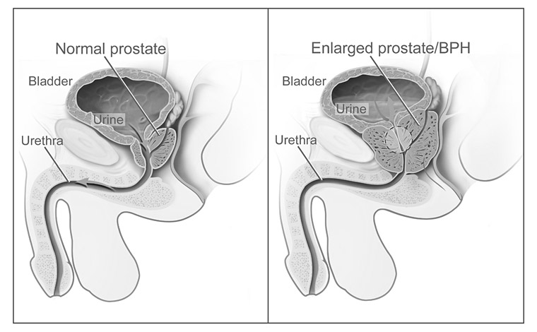 Godartad prostataförstoring (forts.) n Utredning: Ultraljud; cystoskopi; flödesmätning; PSA; ev. biopsi.