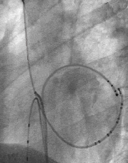 A Ablation vänstersidig WPW-bana B V A V A V A V Ablation V