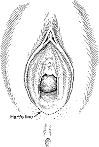 Bakgrund Definition Lokaliserad provocerad vestibulodyni (LPV) är ett komplext smärttillstånd i vestibulum, där smärtan uppstår vid beröring. LPV är synonymt med vestibulit och vulvavestibulit.