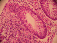 Correlation between faecal calprotectin and inflammatory s Macroscopic s Histological s Extent Severity Extent & Severity Extent Severity Significance (p value) <0.001 0.001 <0.