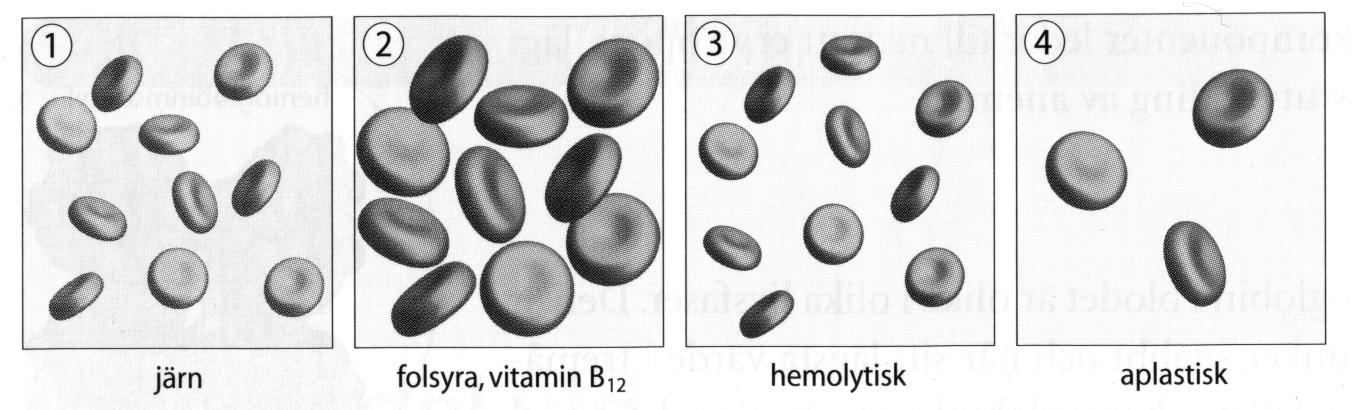 Orsaker till anemi Minskad produktion: q Defekt hemoglobinsyntes q Defekt erytrocytmognad q Stamcellsdefekt Förkortad erytrocytöverlevnadstid: q Medfödd abnormitet i membran, hemoglobin eller