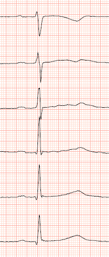 LQT: Varierande penetrans HW, 33 år. Tränar multisport. Har genetiska defekten för LQT2.