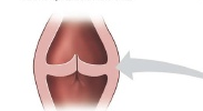 Prenatal dilatation, oligohydramnios