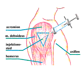 dk, Statens Serum Institut, Köpenhamn Huden över injektionsstället sträcks mellan tummen och de övriga fingrarna.